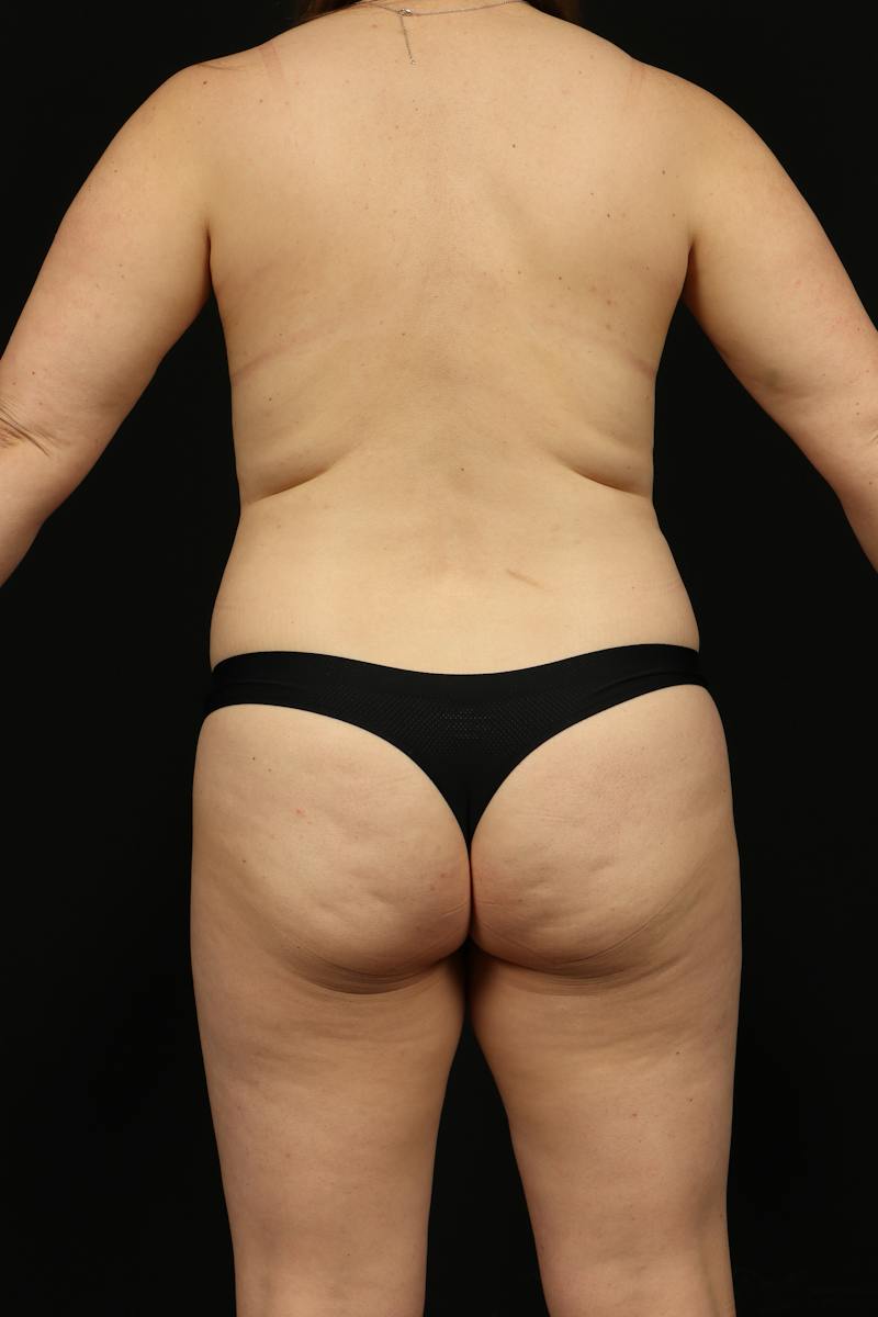 Breast Augmentation Mastopexy Before & After Gallery - Patient 917950 - Image 11