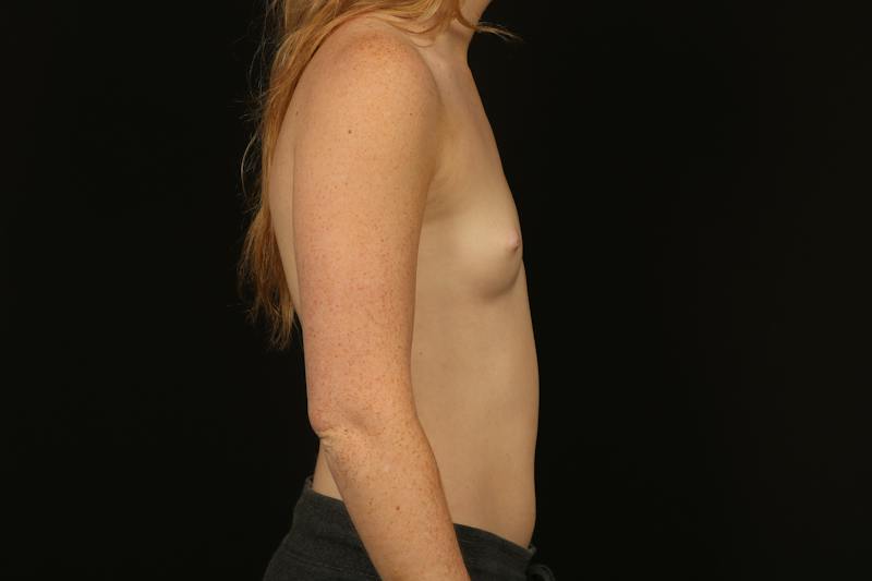 Breast Augmentation Silicone Gel Before & After Gallery - Patient 338514 - Image 9