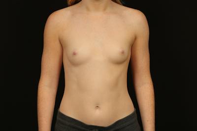 Breast Augmentation Silicone Gel Before & After Gallery - Patient 338514 - Image 1