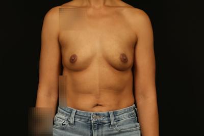 Breast Augmentation Silicone Gel Before & After Gallery - Patient 257818 - Image 1