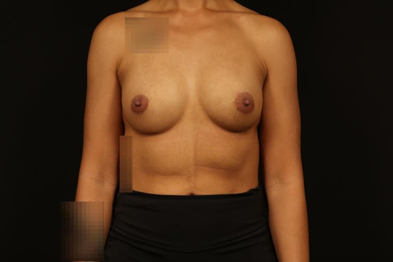 Breast Augmentation Silicone Gel Before & After Gallery - Patient 257818 - Image 2