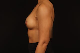 Breast Augmentation Silicone Gel Before & After Gallery - Patient 257818 - Image 6