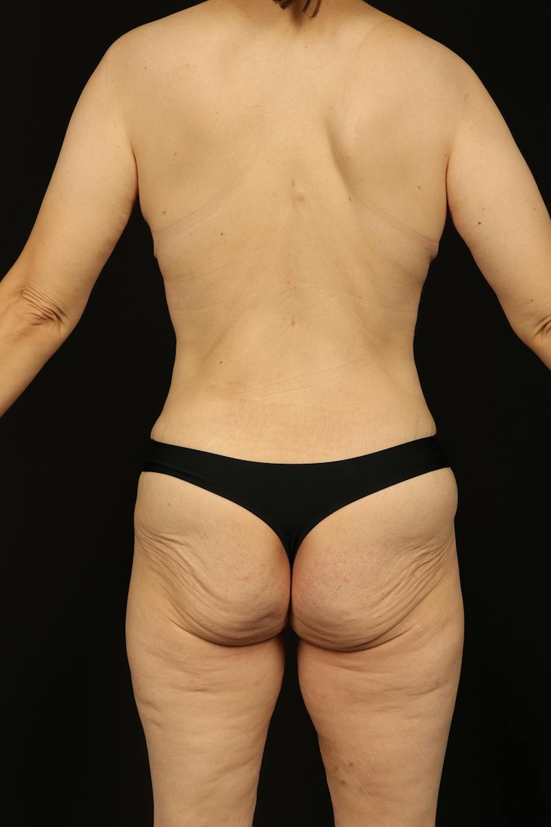 Mastopexy Before & After Gallery - Patient 242903 - Image 12