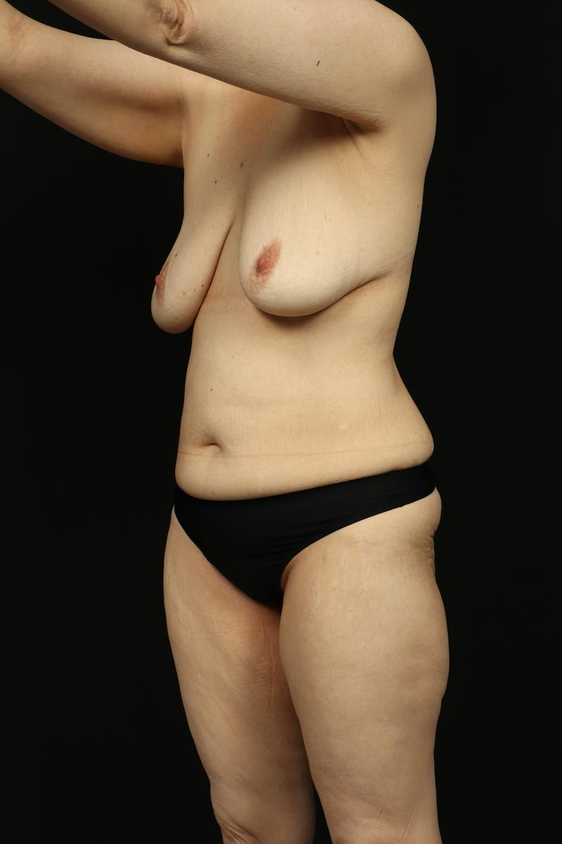 Mastopexy Before & After Gallery - Patient 242903 - Image 3