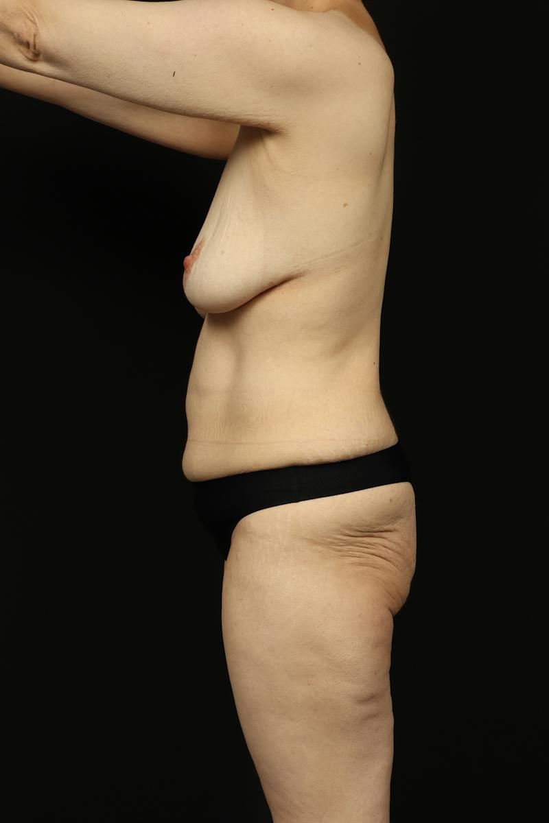 Mastopexy Before & After Gallery - Patient 242903 - Image 5