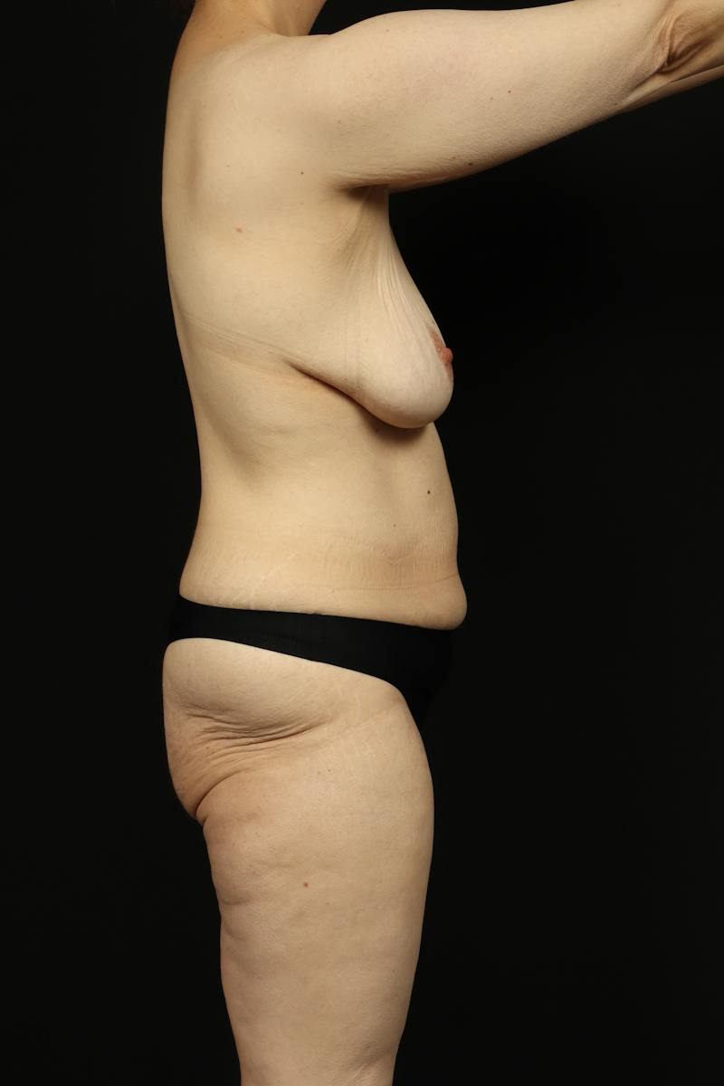 Mastopexy Before & After Gallery - Patient 242903 - Image 9
