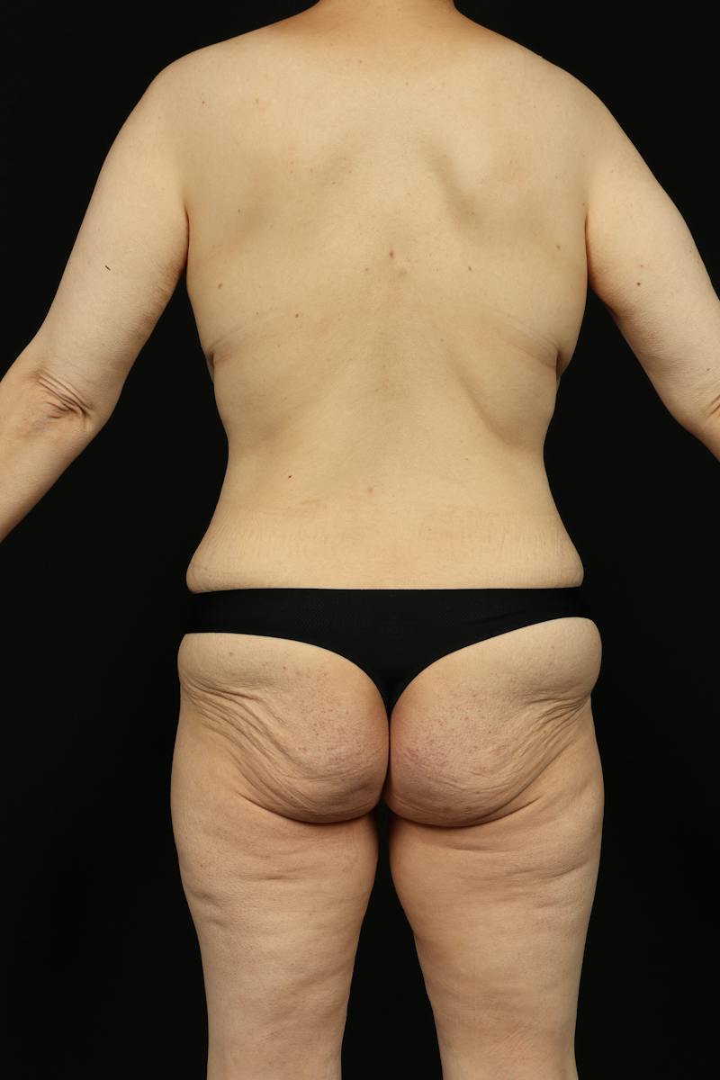 Mastopexy Before & After Gallery - Patient 242903 - Image 11