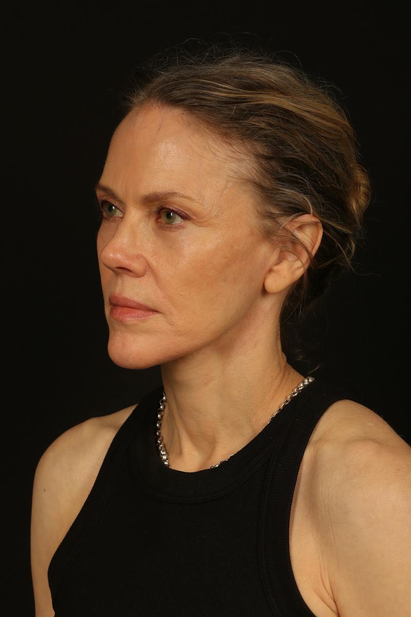 Facelift Before & After Gallery - Patient 383311 - Image 4