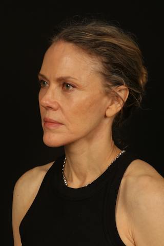 Facelift Before & After Gallery - Patient 383311 - Image 4
