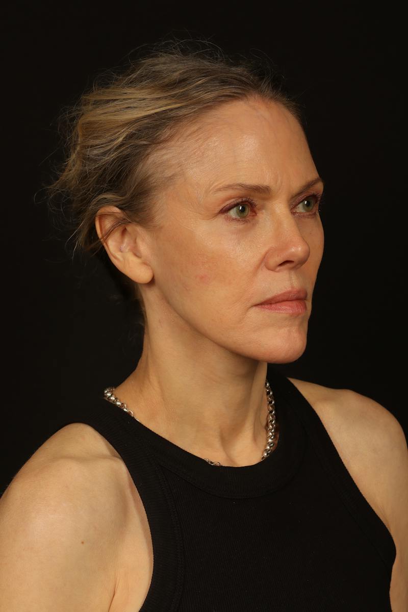 Facelift Before & After Gallery - Patient 383311 - Image 8
