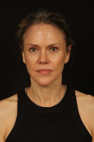 Facelift Before & After Gallery - Patient 383311 - Image 2