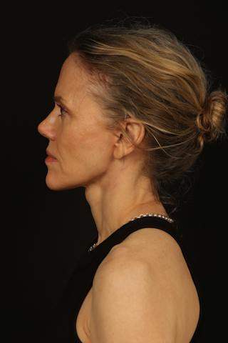 Facelift Before & After Gallery - Patient 383311 - Image 6