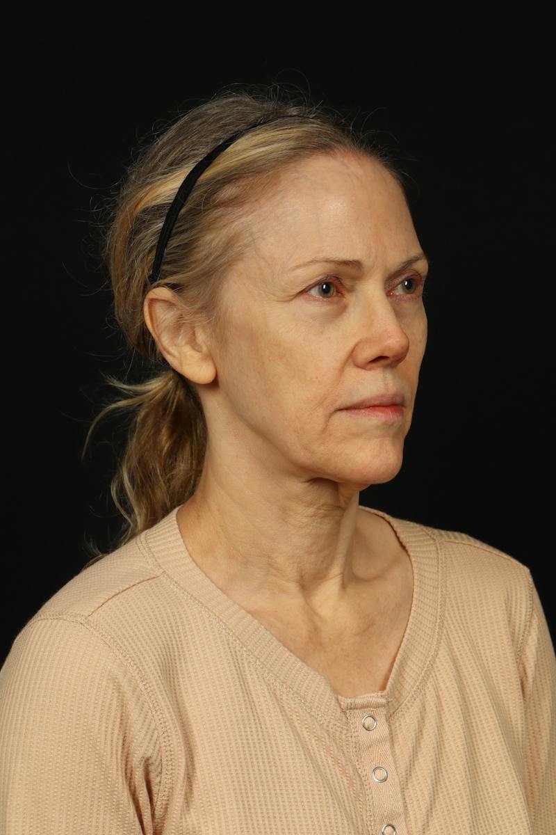 Facelift Before & After Gallery - Patient 383311 - Image 7