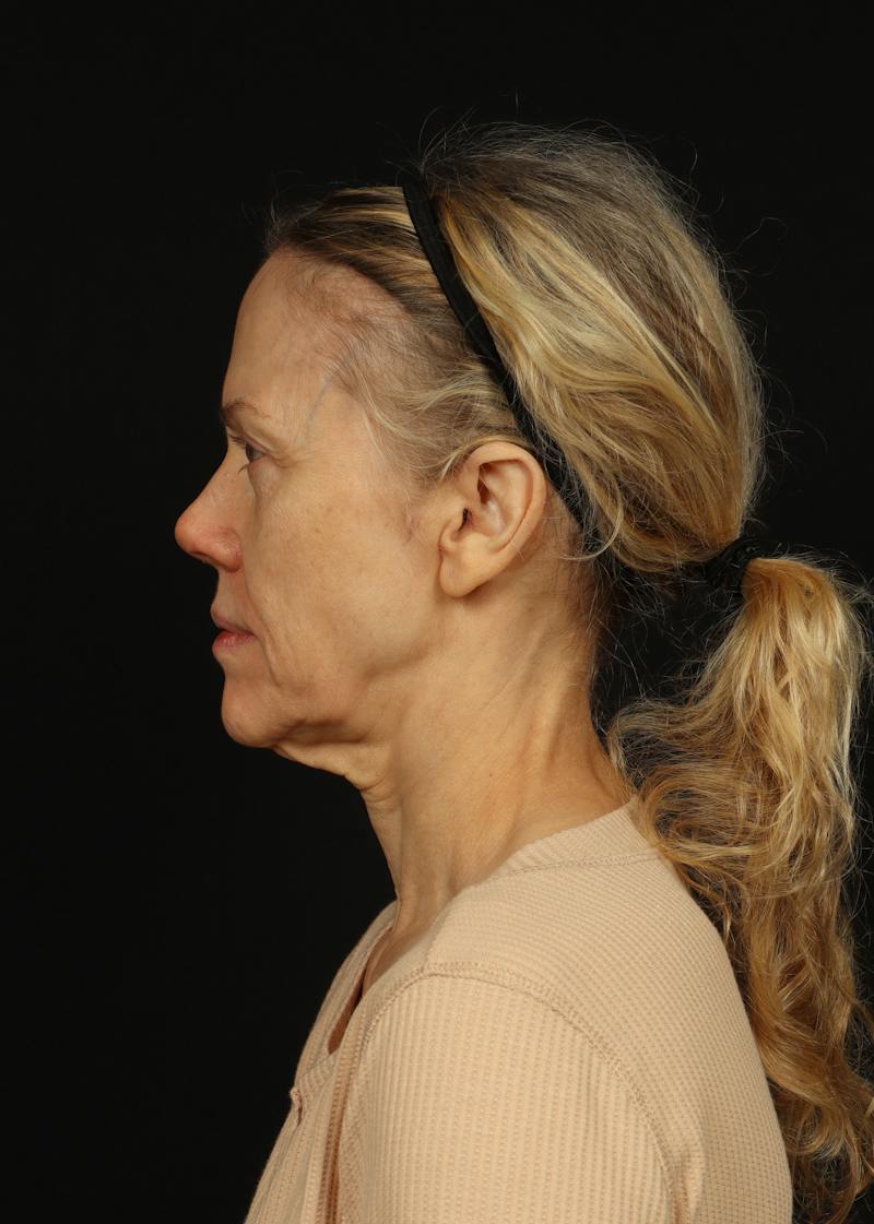 Facelift Before & After Gallery - Patient 383311 - Image 5
