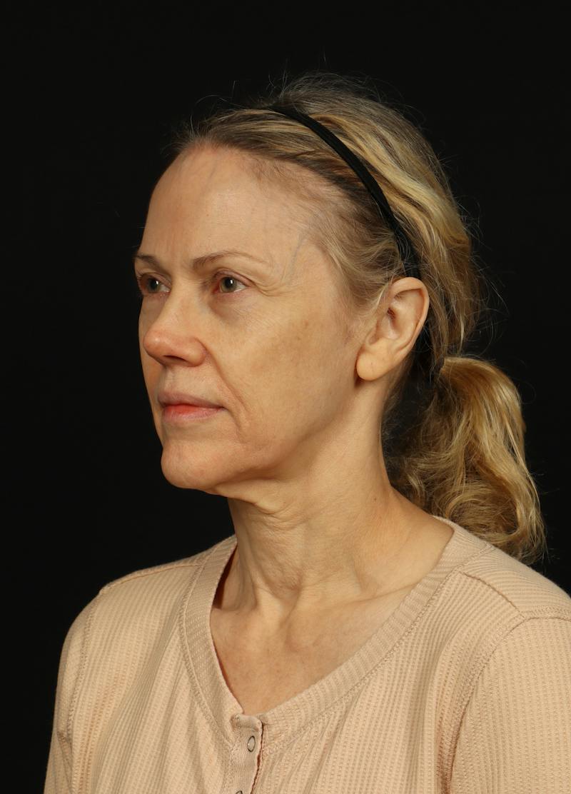 Facelift Before & After Gallery - Patient 383311 - Image 3