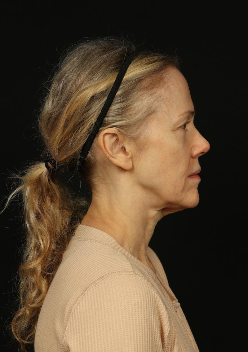 Facelift Before & After Gallery - Patient 383311 - Image 9