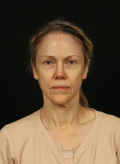 Facelift Before & After Gallery - Patient 383311 - Image 1