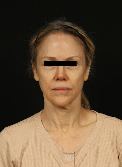 Facelift Before & After Gallery - Patient 383311 - Image 1
