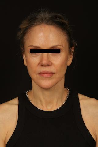 Facelift Before & After Gallery - Patient 383311 - Image 2