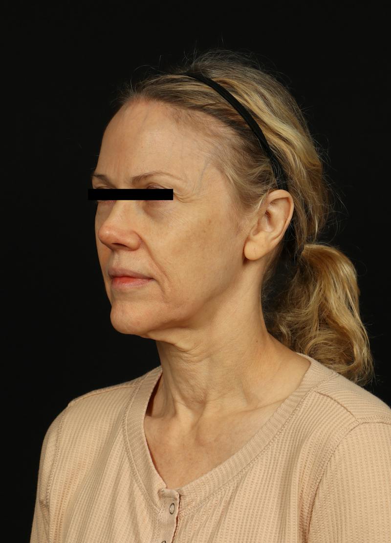 Facelift Before & After Gallery - Patient 383311 - Image 3