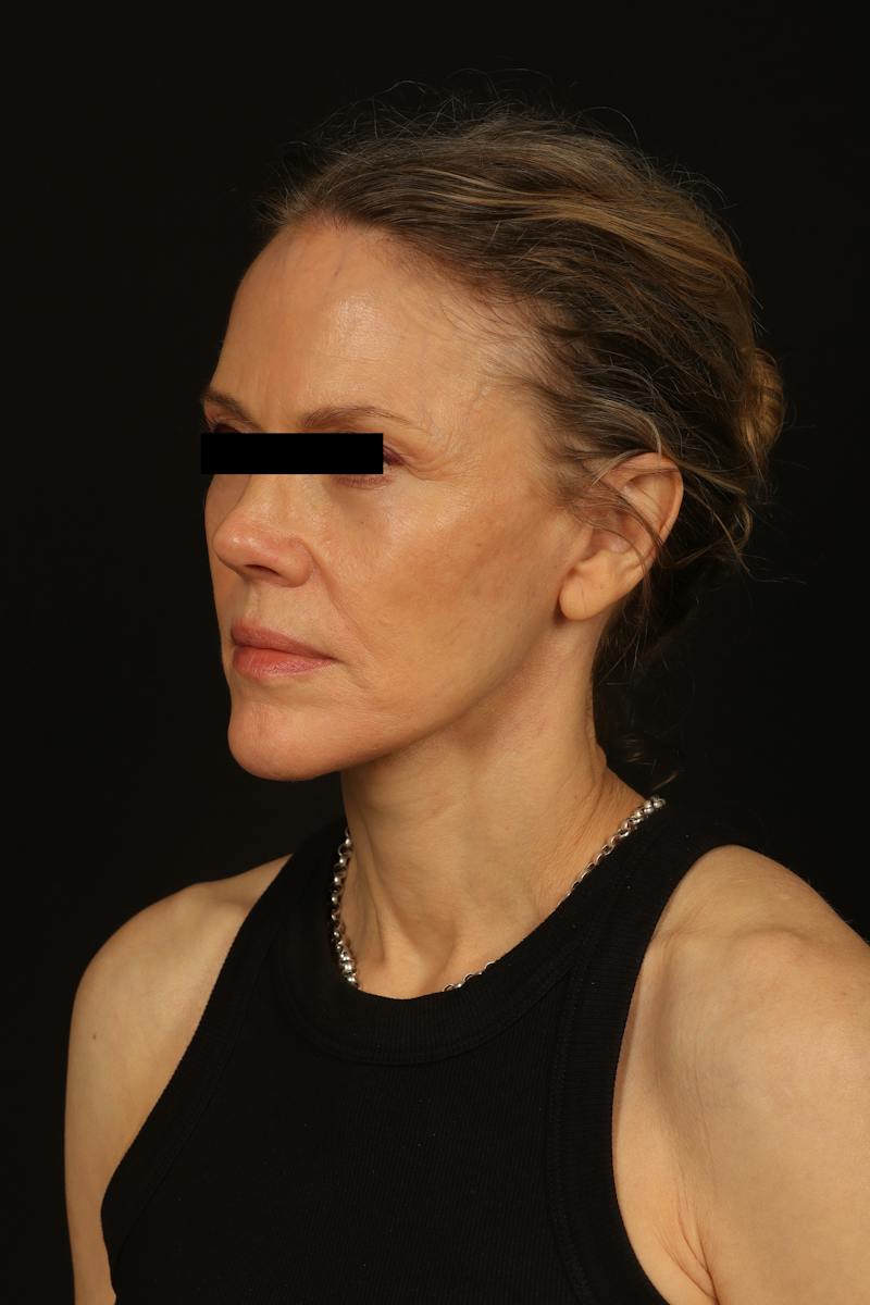Facelift Before & After Gallery - Patient 383311 - Image 4