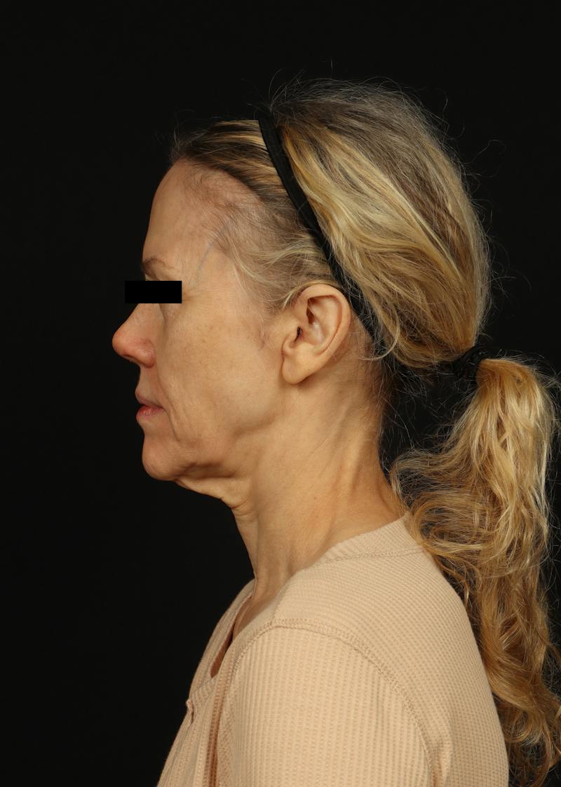 Facelift Before & After Gallery - Patient 383311 - Image 5