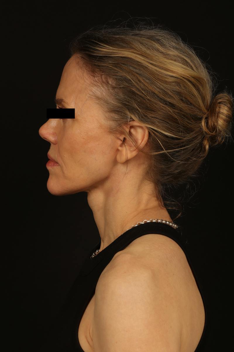 Facelift Before & After Gallery - Patient 383311 - Image 6