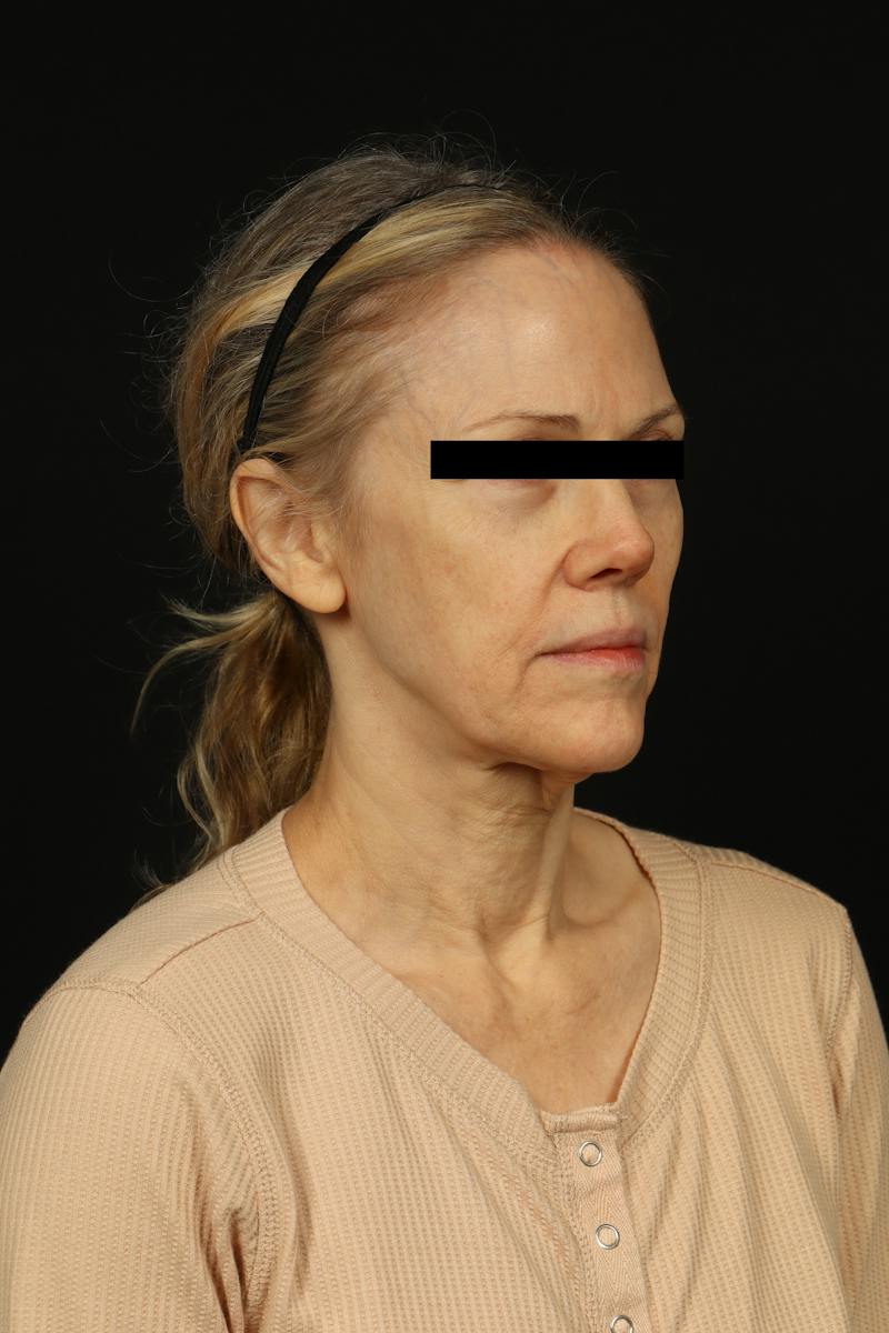 Facelift Before & After Gallery - Patient 383311 - Image 7