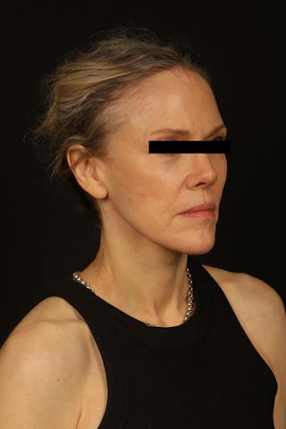 Facelift Before & After Gallery - Patient 383311 - Image 8