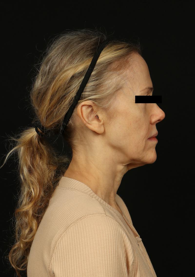 Facelift Before & After Gallery - Patient 383311 - Image 9