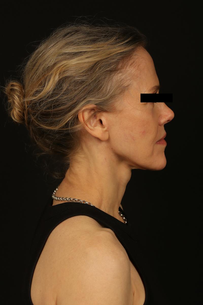 Facelift Before & After Gallery - Patient 383311 - Image 10