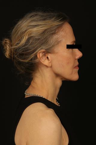 Facelift Before & After Gallery - Patient 383311 - Image 10