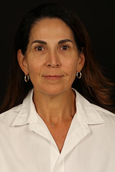 Facelift Before & After Gallery - Patient 469386 - Image 1
