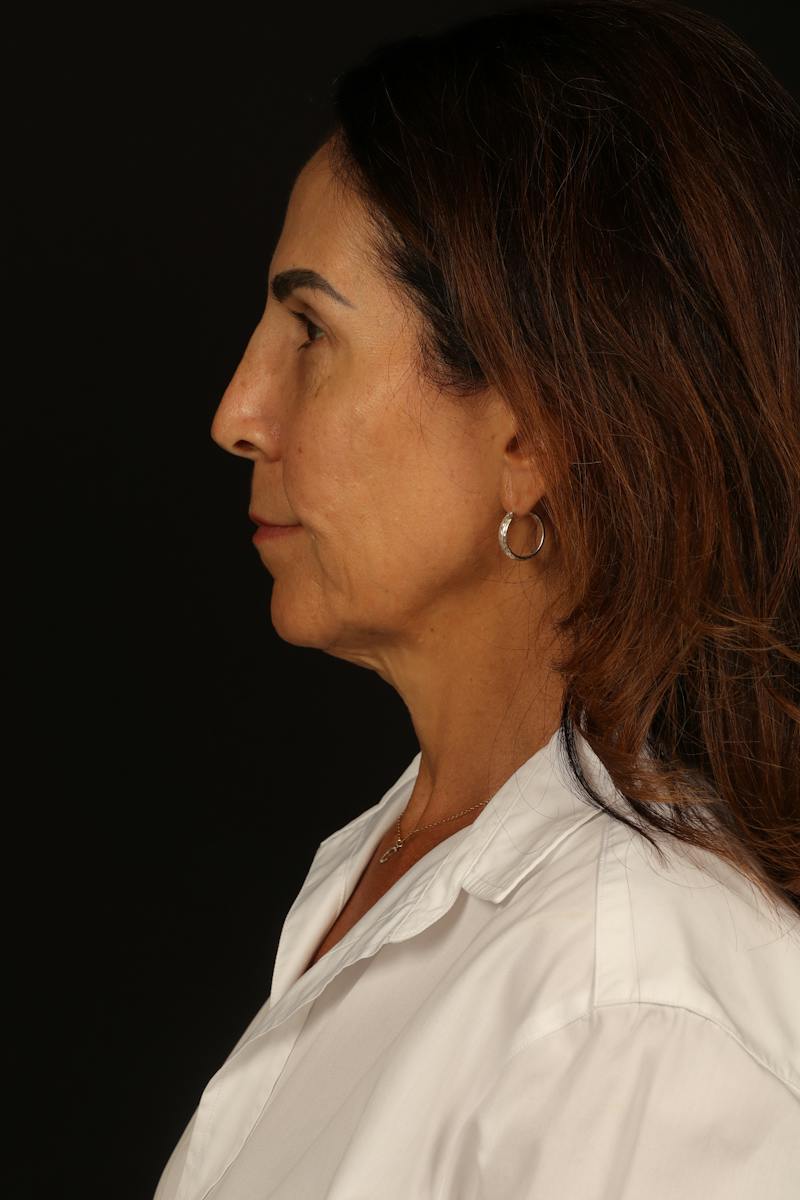 Facelift Before & After Gallery - Patient 469386 - Image 5