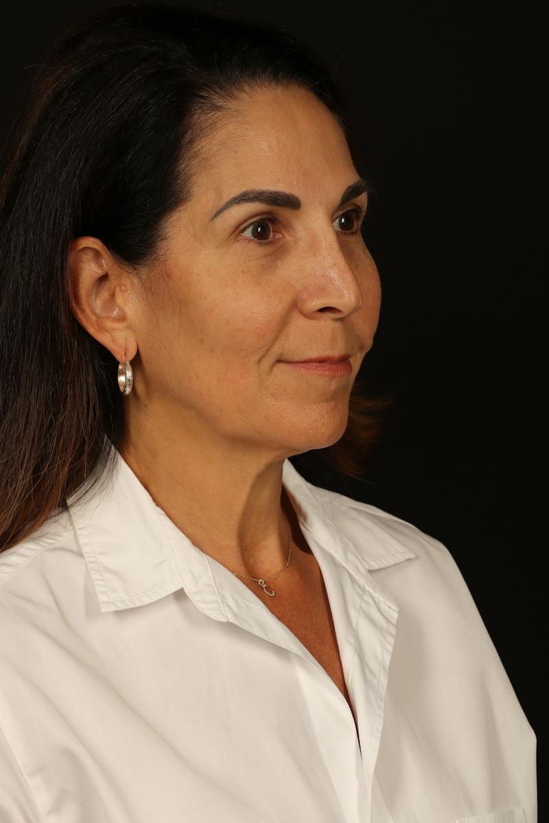 Facelift Before & After Gallery - Patient 469386 - Image 7