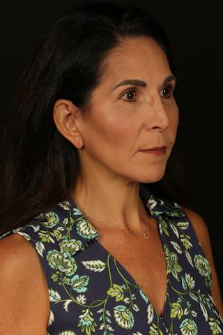 Facelift Before & After Gallery - Patient 469386 - Image 8