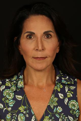 Facelift Before & After Gallery - Patient 469386 - Image 2