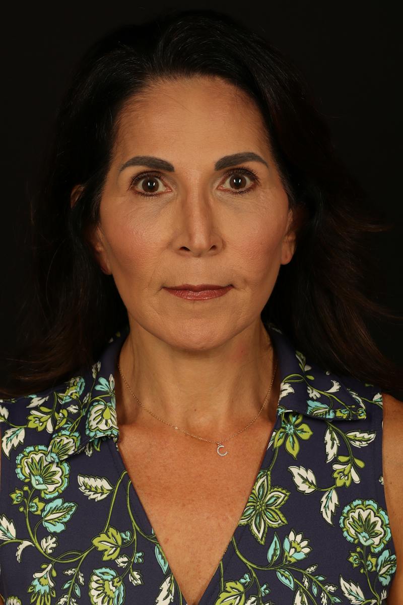 Facelift Before & After Gallery - Patient 469386 - Image 2