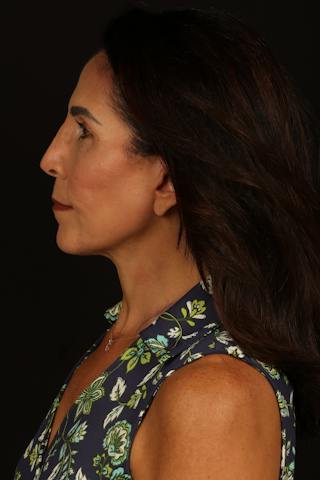 Facelift Before & After Gallery - Patient 469386 - Image 6