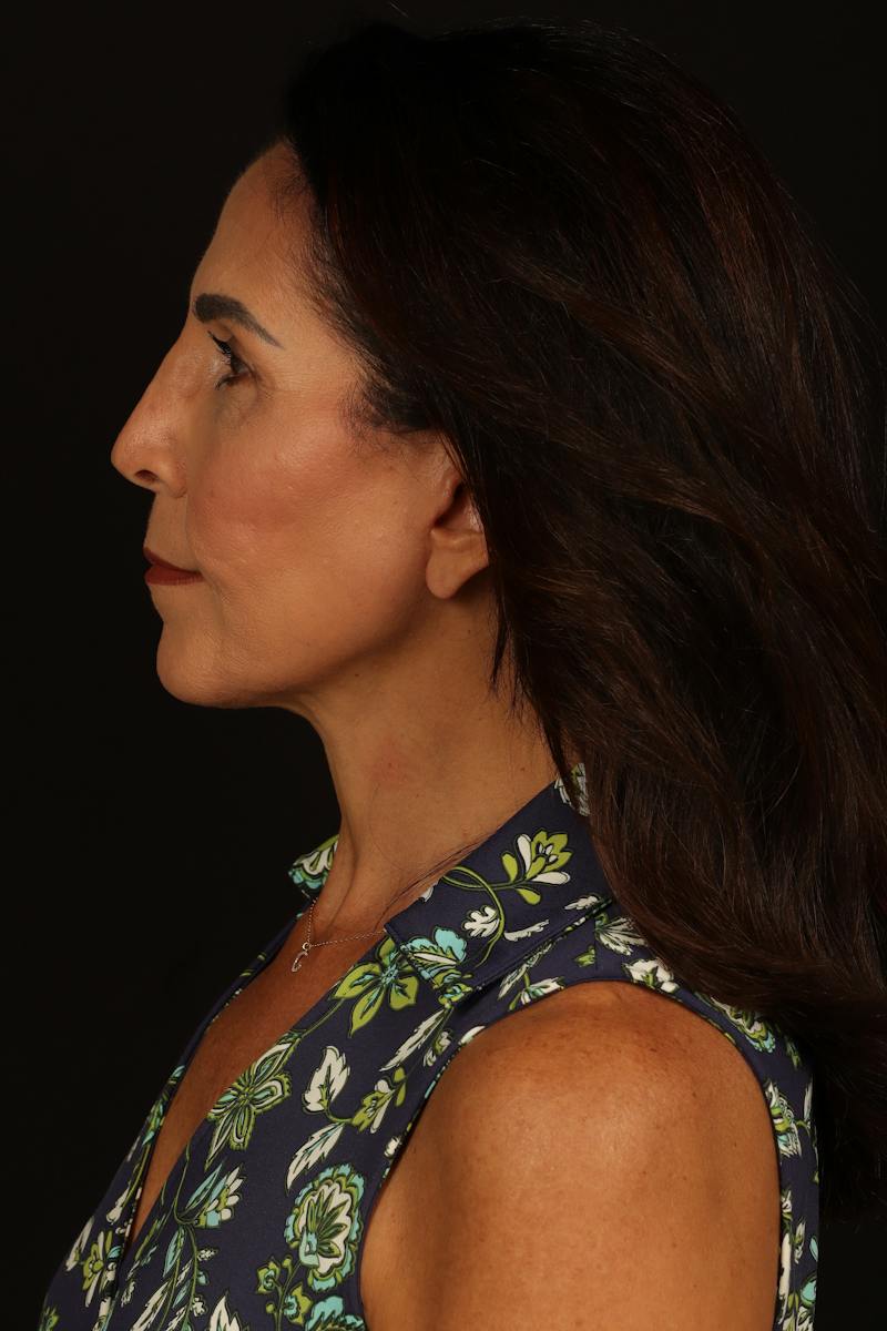 Facelift Before & After Gallery - Patient 469386 - Image 6