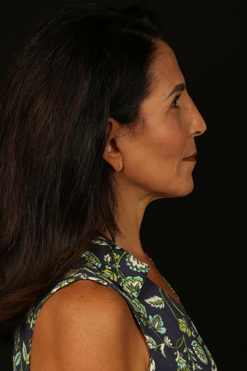 Facelift Before & After Gallery - Patient 469386 - Image 10