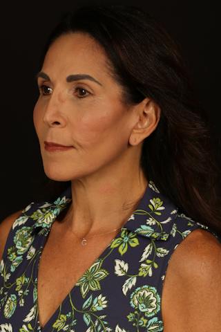 Facelift Before & After Gallery - Patient 469386 - Image 4