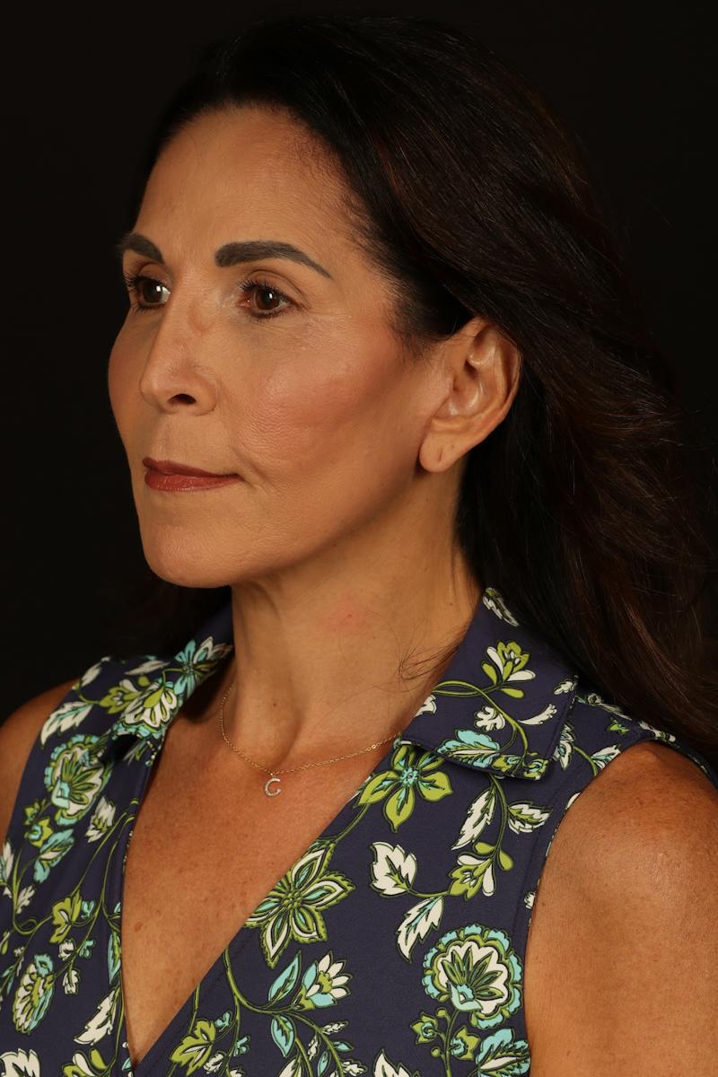 Facelift Before & After Gallery - Patient 469386 - Image 4