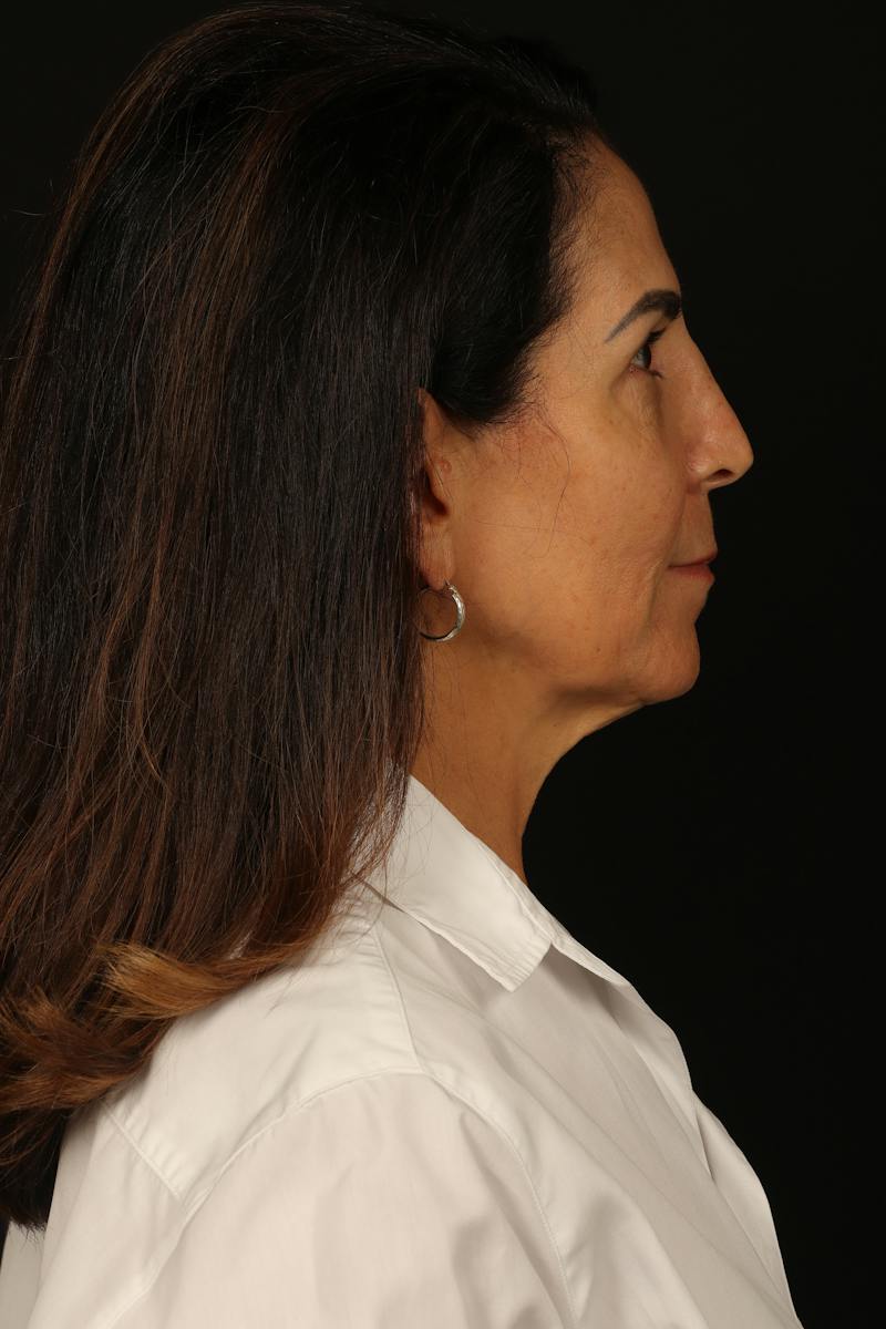 Facelift Before & After Gallery - Patient 469386 - Image 9