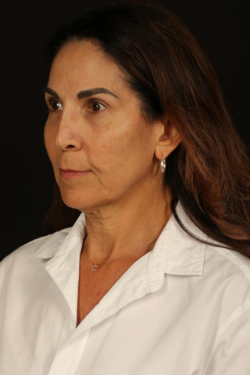 Facelift Before & After Gallery - Patient 469386 - Image 3