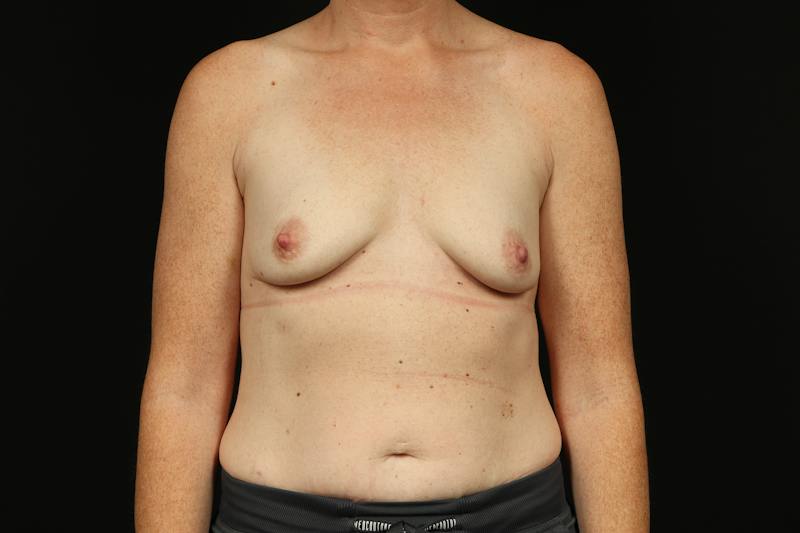 Breast Augmentation Mastopexy Before & After Gallery - Patient 196311 - Image 1