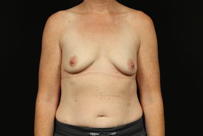 Breast Augmentation Mastopexy Before & After Gallery - Patient 196311 - Image 1