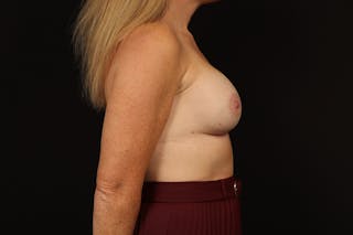 Breast Augmentation Mastopexy Before & After Gallery - Patient 196311 - Image 10