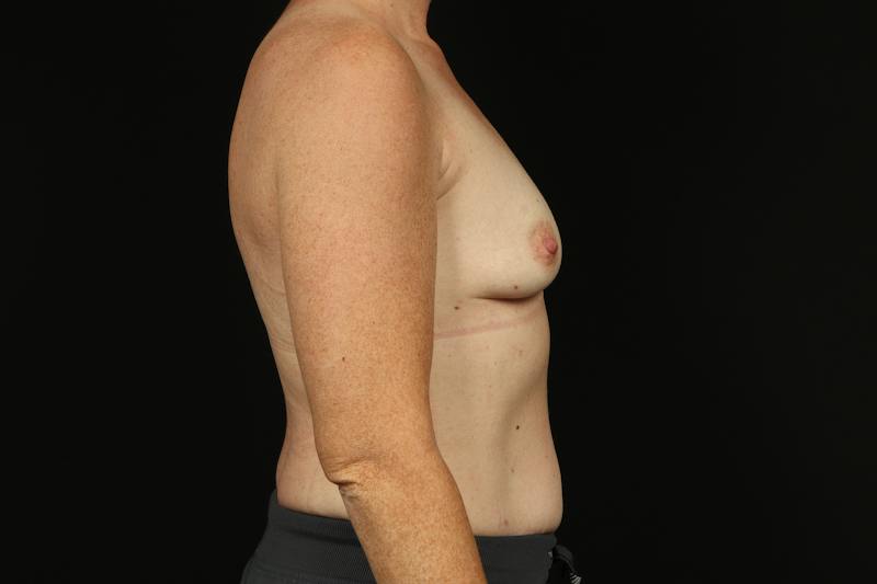 Breast Augmentation Mastopexy Before & After Gallery - Patient 196311 - Image 9