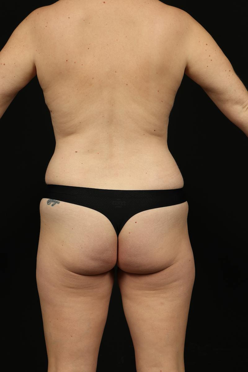 360 Liposuction Before & After Gallery - Patient 394725 - Image 7